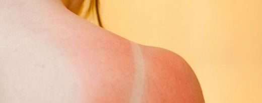 Casos de mala praxis al tomar el sol este verano