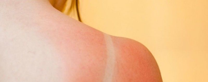 Casos de mala praxis al tomar el sol este verano