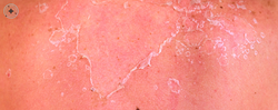 ¿Cómo evitar que la piel se pele en verano? La guía definitiva para mantener un bronceado bonito y una piel sana