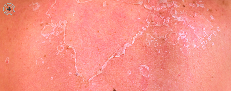 ¿Cómo evitar que la piel se pele en verano? La guía definitiva para mantener un bronceado bonito y una piel sana